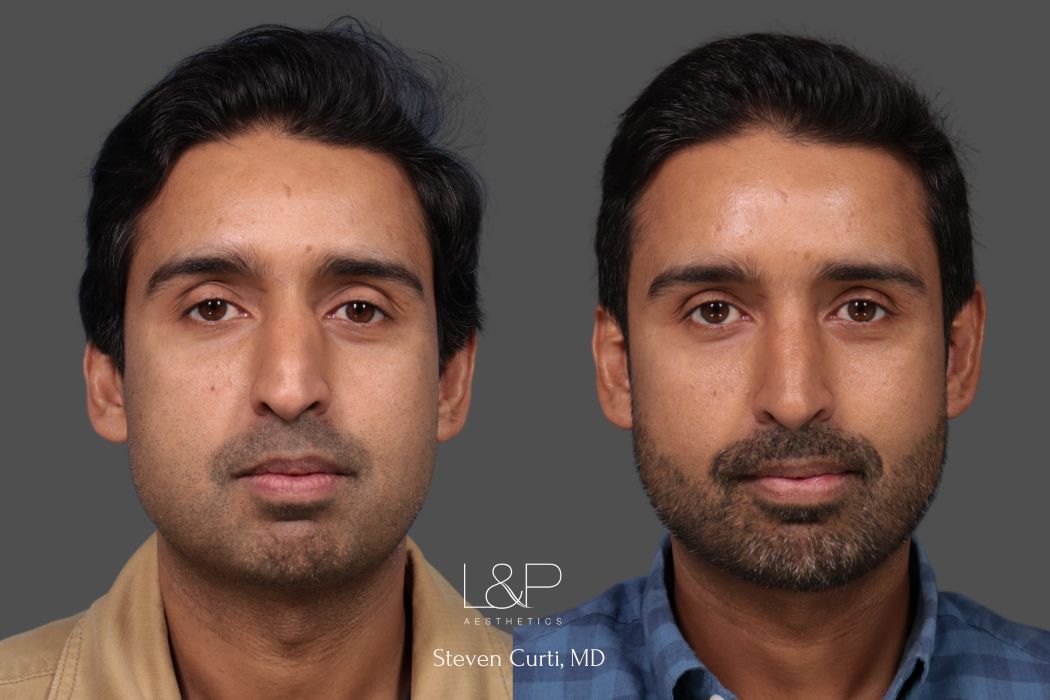 male rhinoplasty and buccal fat removal front view - L&P Aesthetics