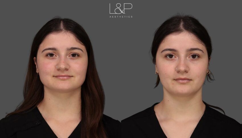 facial balancing with botox, case 26 - front view
