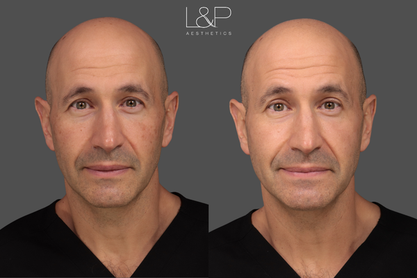 MoxiBBL before/after