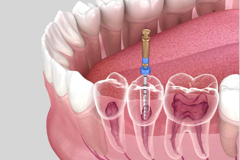 Endodontic root canal treatment process