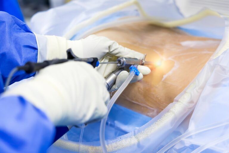 Doctor in blue uniform does minimal invasive endoscopic keyhole spine surgery