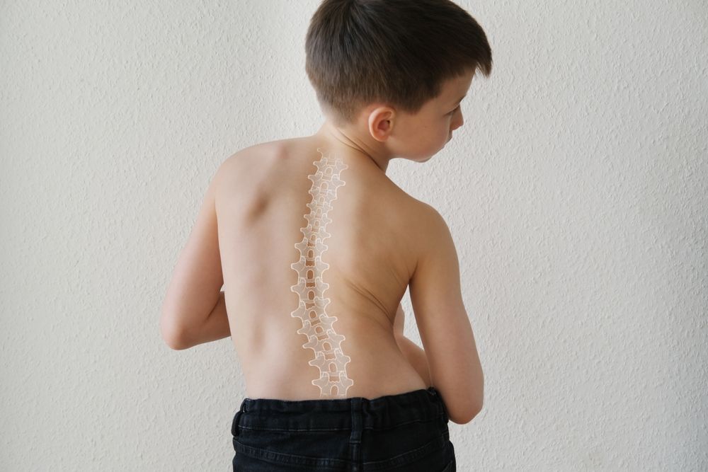 naked back of boy, child 8-10 years old bent over from back pain, curved spine
