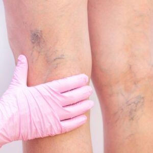 Varicose veins