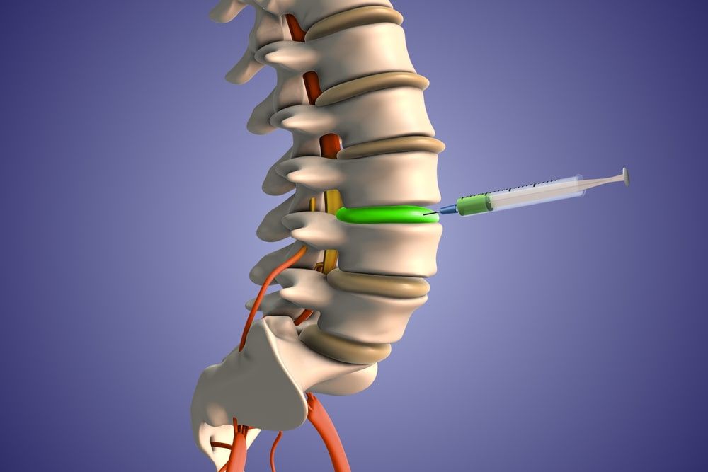 Injecting steroids to treat herniated disc pain 3D Illustration