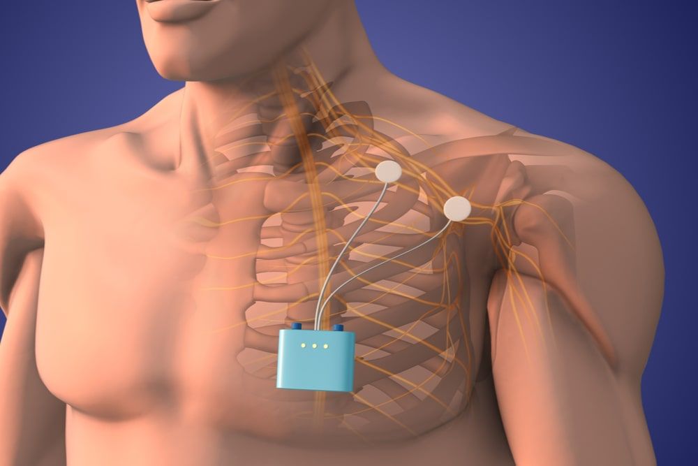 Peripheral nerve stimulation therapy in shoulder area 3D Illustration