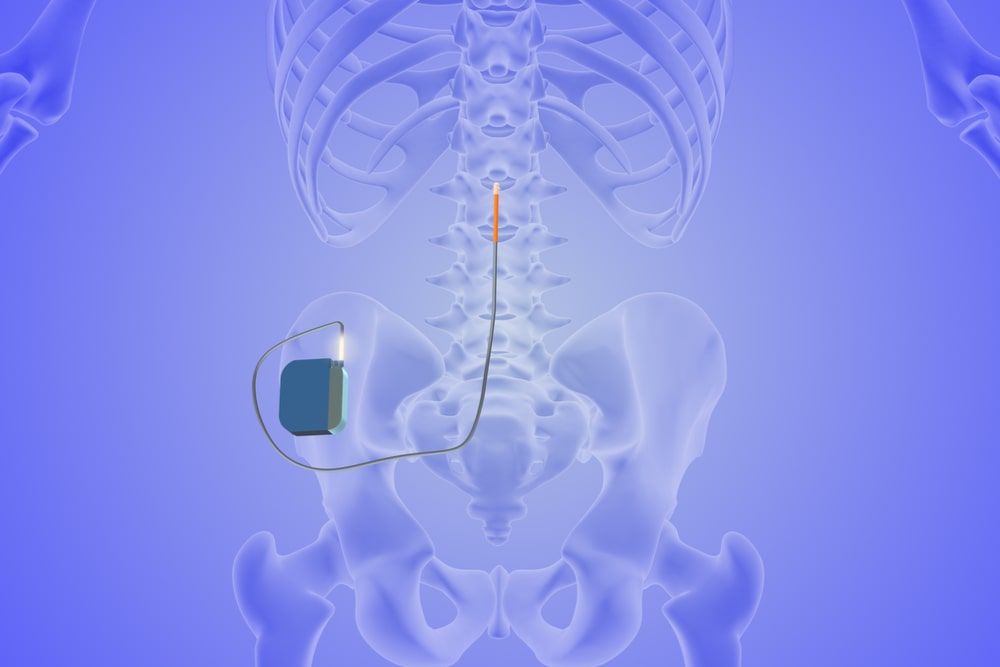 The medical notion of spinal cord stimulation 3D Illustration