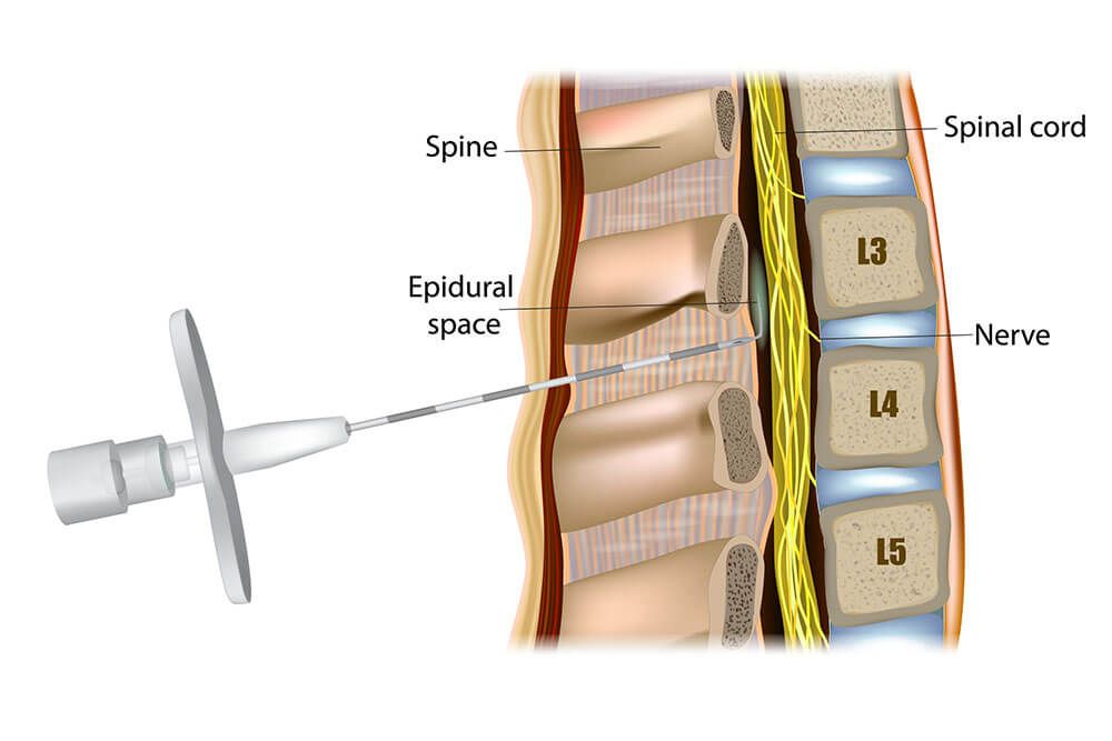 Medicine is injected into the epidural space around the spinal cord