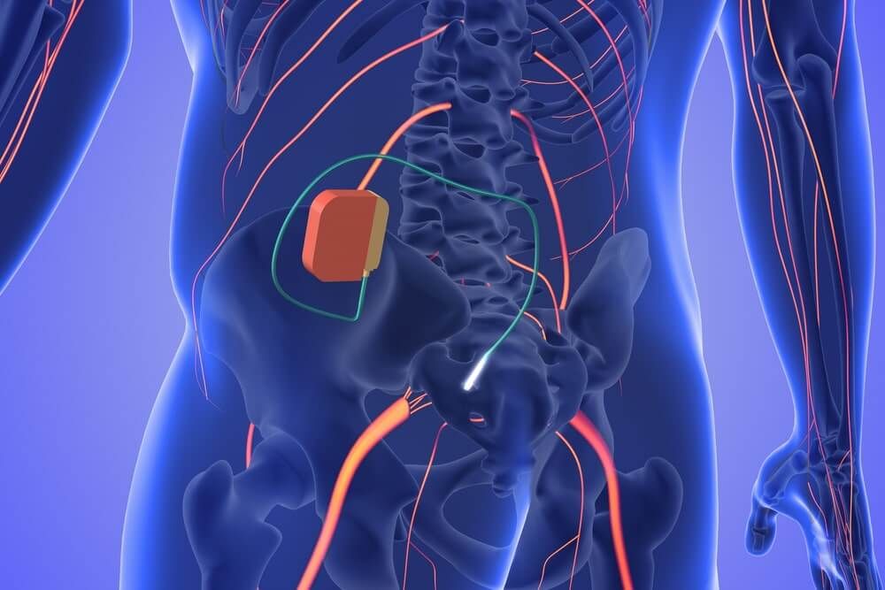 Sacral nerve stimulation medical concept 3D Illustration