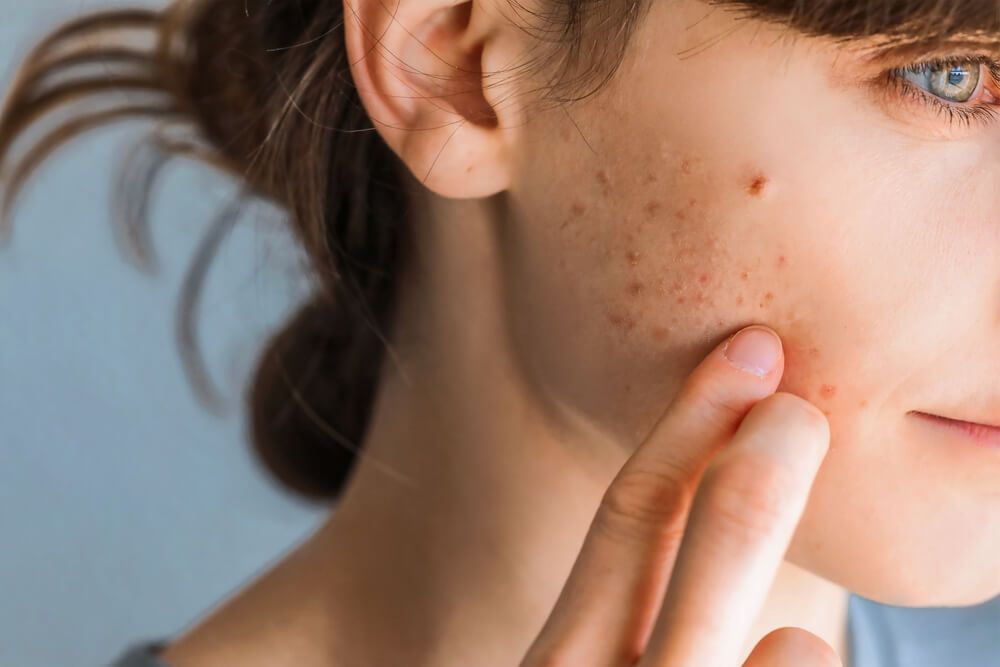 Woman with red cheeks- diathesis symptoms