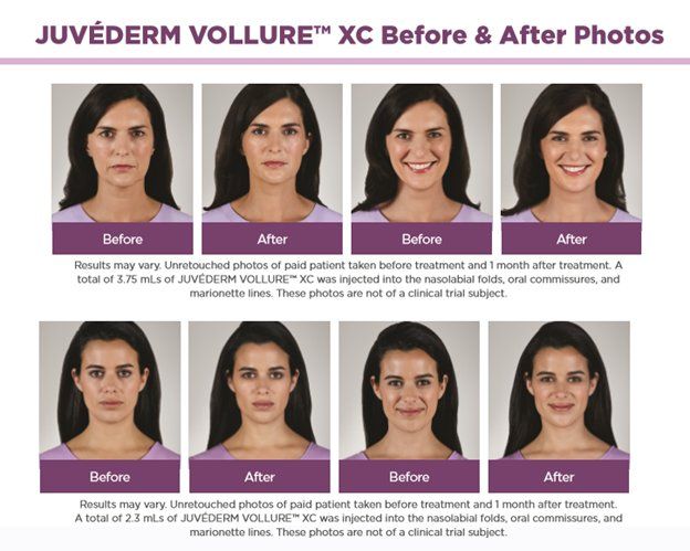 Before and after Juvederm Vollure treatment