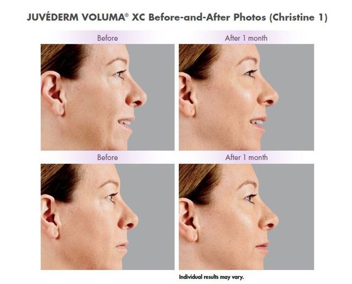 Before and after Juvederm Voluma XC treatment