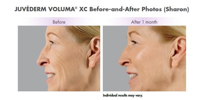 Before and after Juvederm Voluma XC treatment