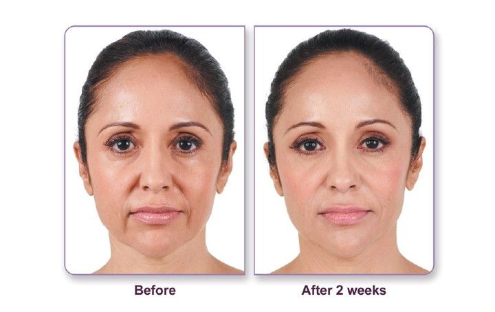Before and after Juvederm XC treatment
