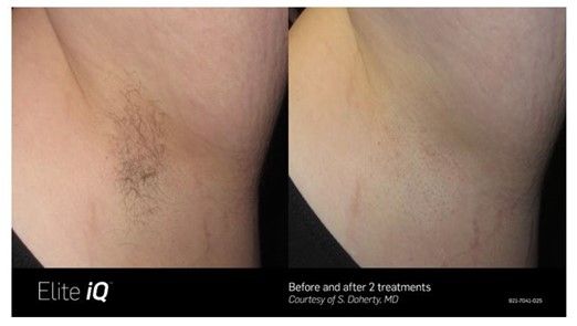 Before and after Laser Hair Removal treatment