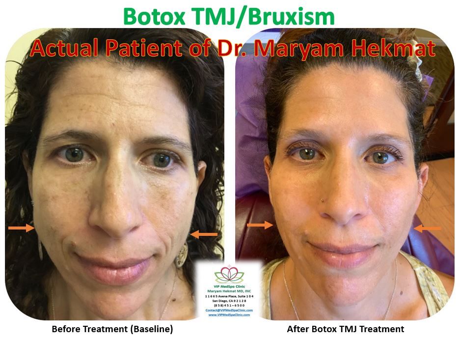 Botox-TMJ-before-and-after