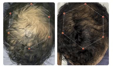 Before and after Hair Restoration treatment