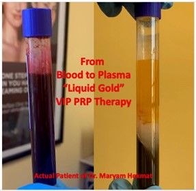 From blood to plasma "liquid Gold" VIP PRP Therapy