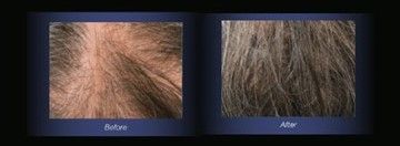Before and after Hair Restoration treatment