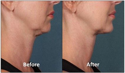 Before and after Kybella treatment