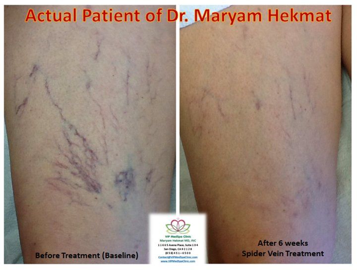 Before and after Laser Spider Vein treatment