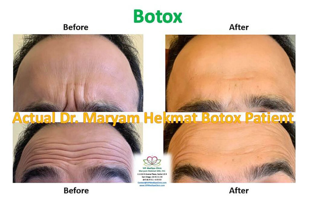 Botox For Men VIP MedSpa Clinic
