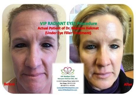 Before and after Radiant Eyes treatment