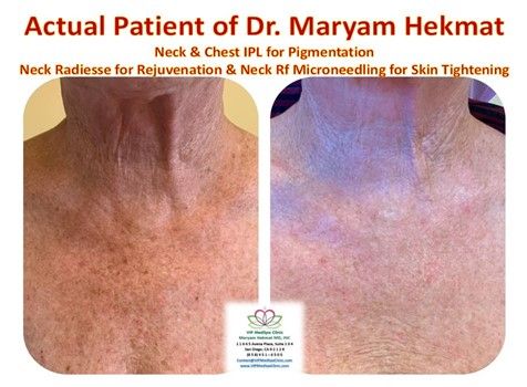 Before and after Skin Rejuvenation treatment