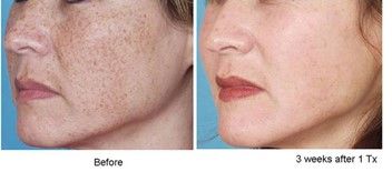 Before and after Skin Rejuvenation treatment