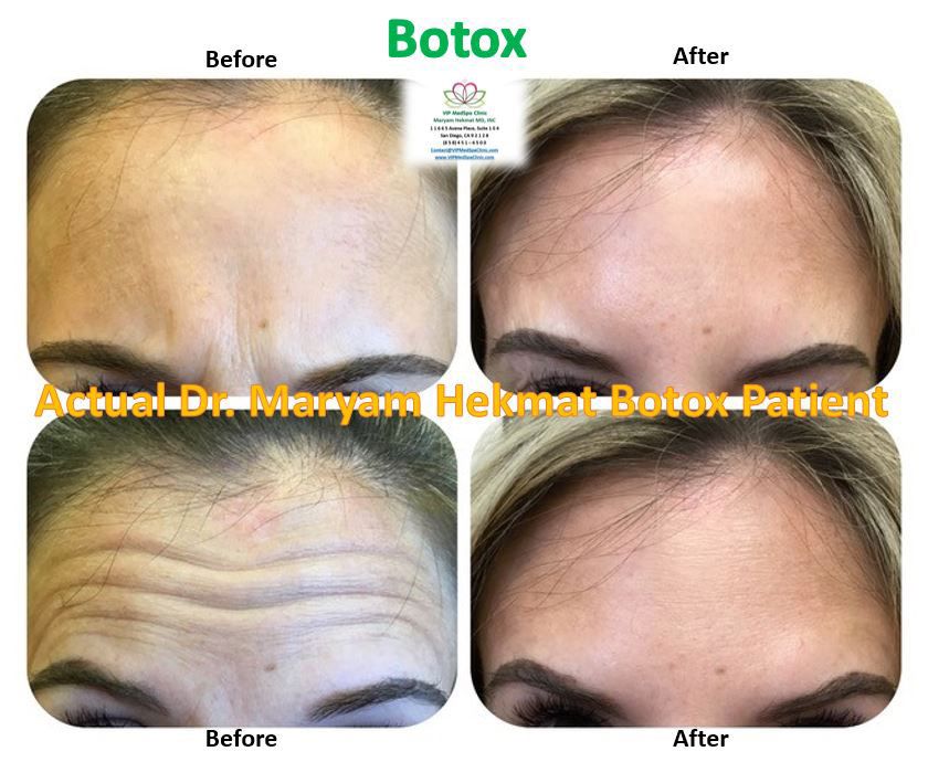 women-botox-before-and-after-1