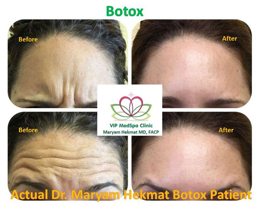 women-botox-before-and-after-2