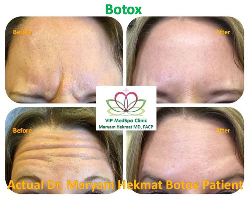 women-botox-before-and-after-3