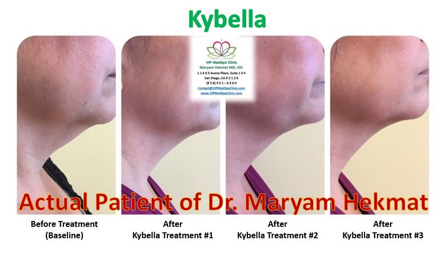 kybella-before-and-after-website-1