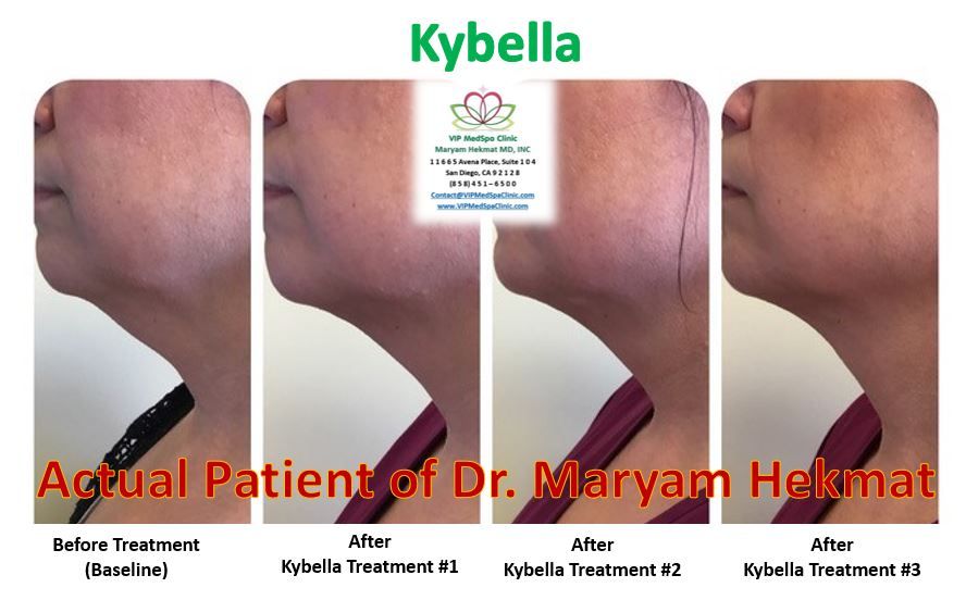 kybella-before-and-after-website-2