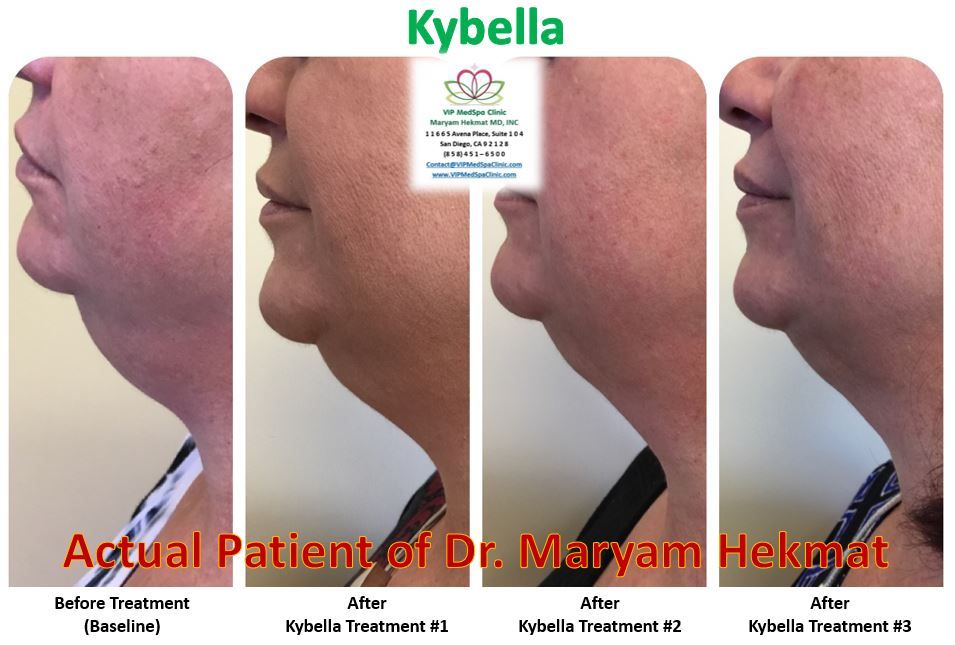 kybella-before-and-after-website-3