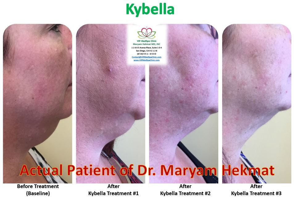 kybella-before-and-after-website-4