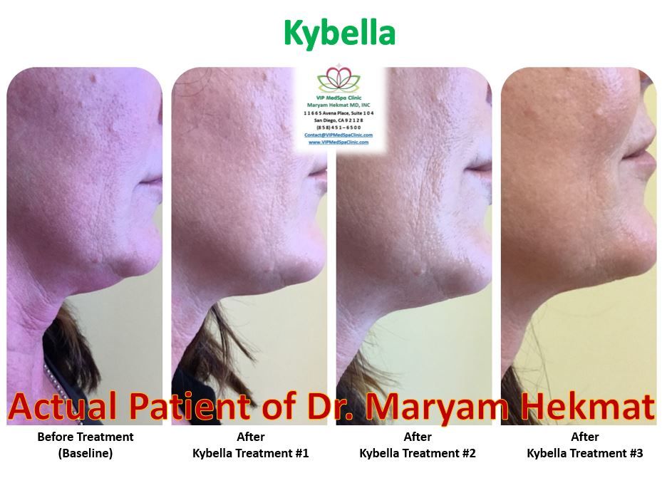 kybella-before-and-after-website-5
