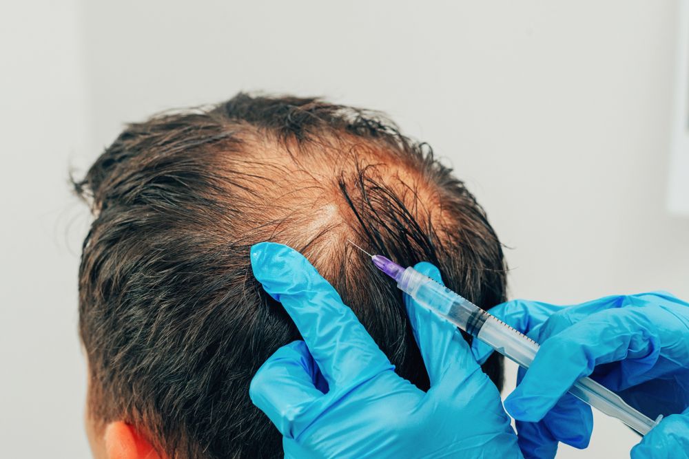 PRP Therapy for Hair Restoration: Benefits and Process