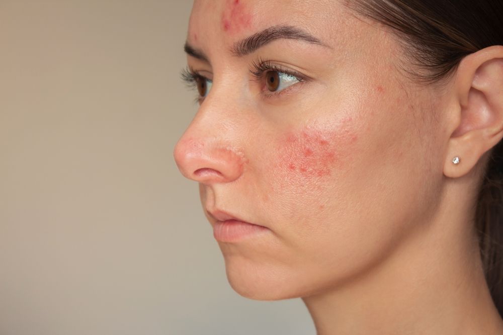 Combatting Acne with Top Skincare Ingredients