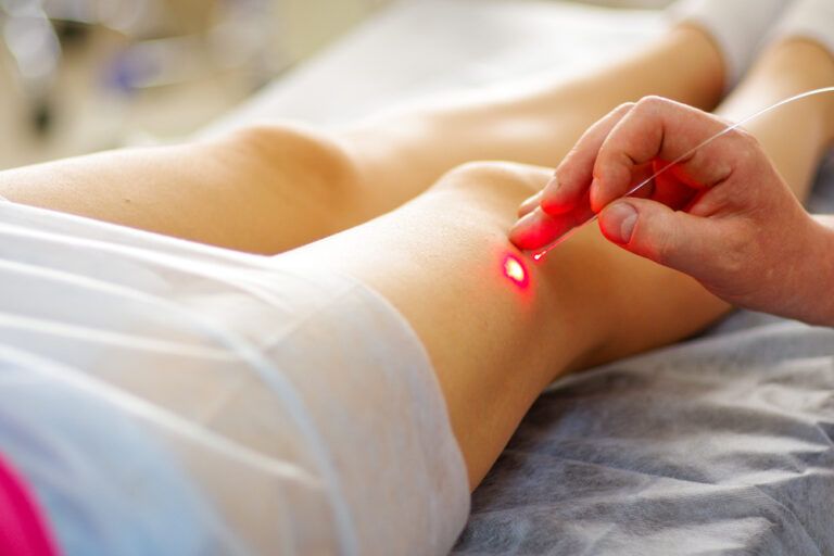 Varicose laser treatment on female legs in clinic