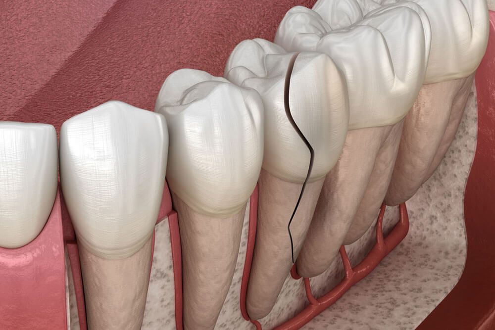 Cracked tooth, splitted. Medically accurate 3D illustration