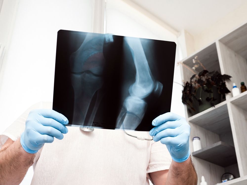 REVISION JOINT REPLACEMENT