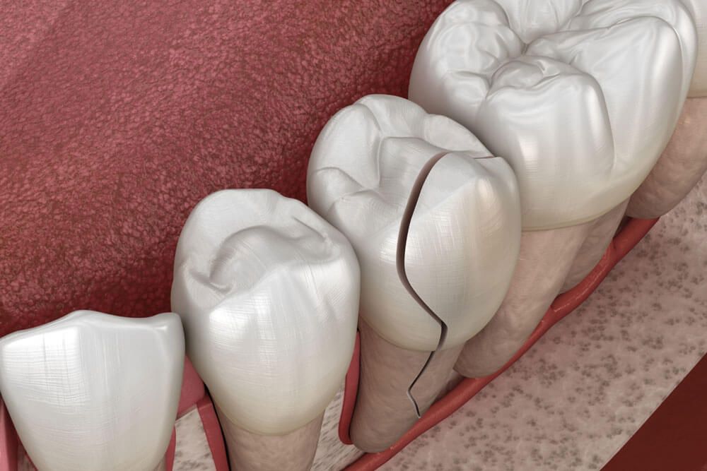 Cracked tooth, splitted. Medically accurate 3D illustration