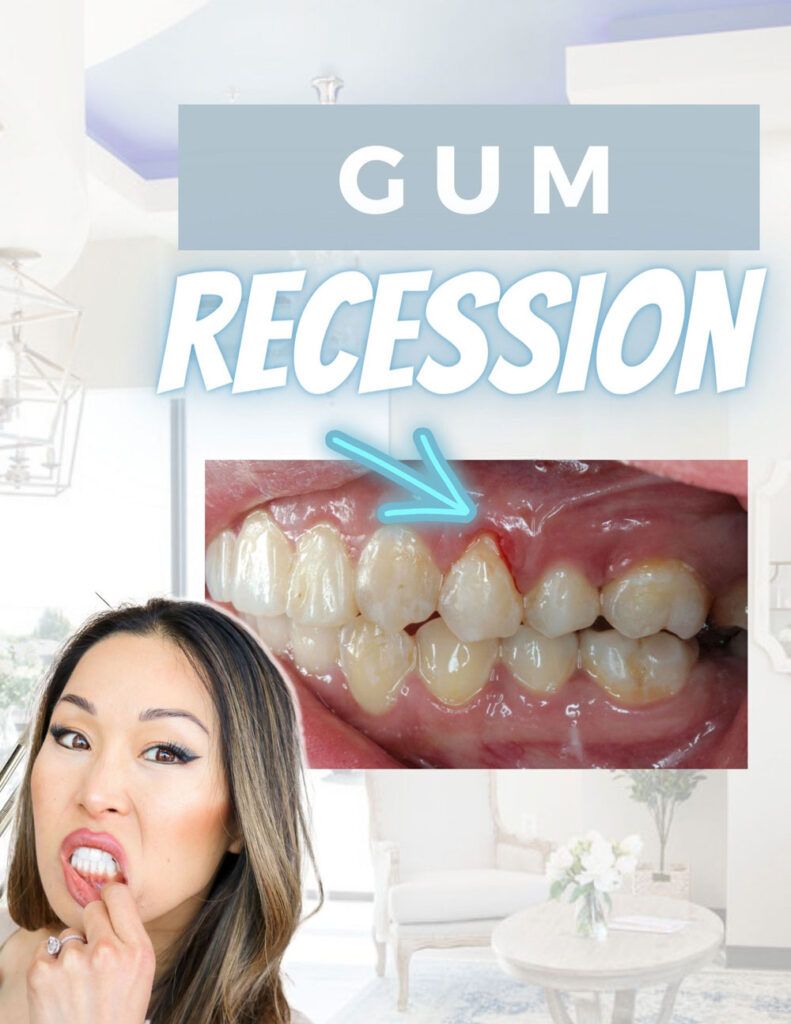 How to prevent gum recession