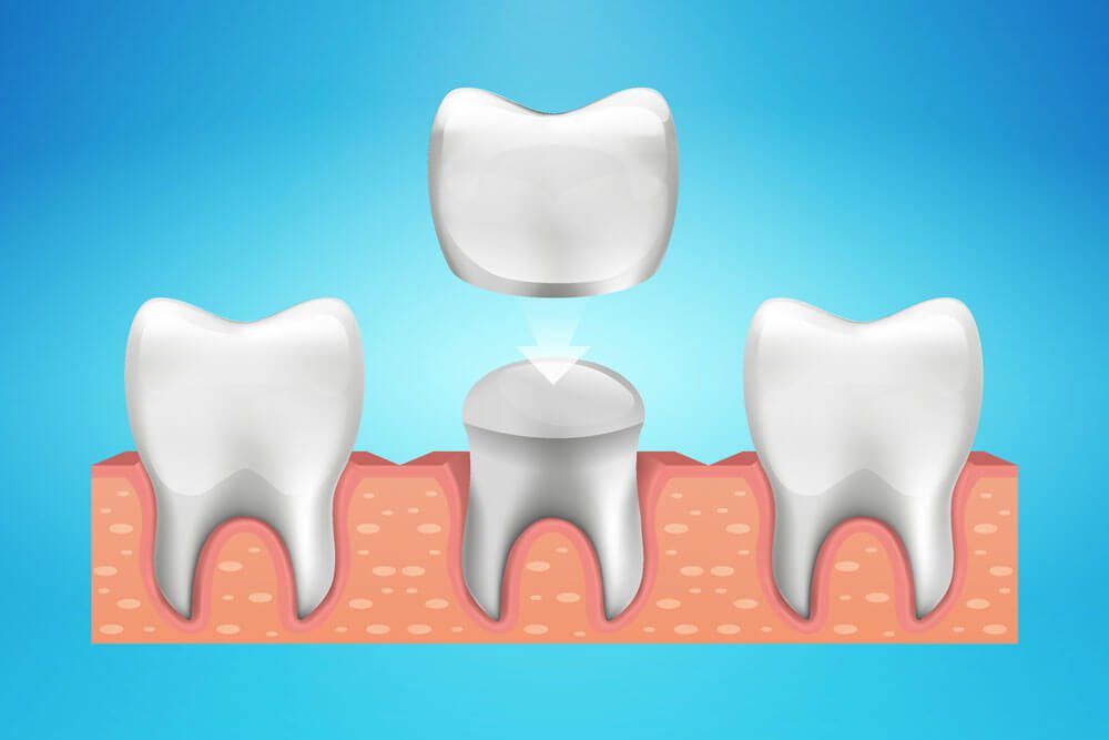Dental Crown Restoration in Vector illustration