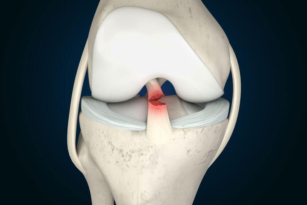 Anterior Cruciate Ligament Tear 3D Rendering