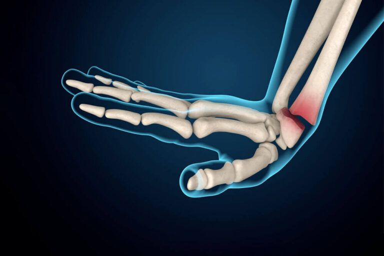 Fracture Care Greenfield, IN Shively Orthopedic Sports Medicine