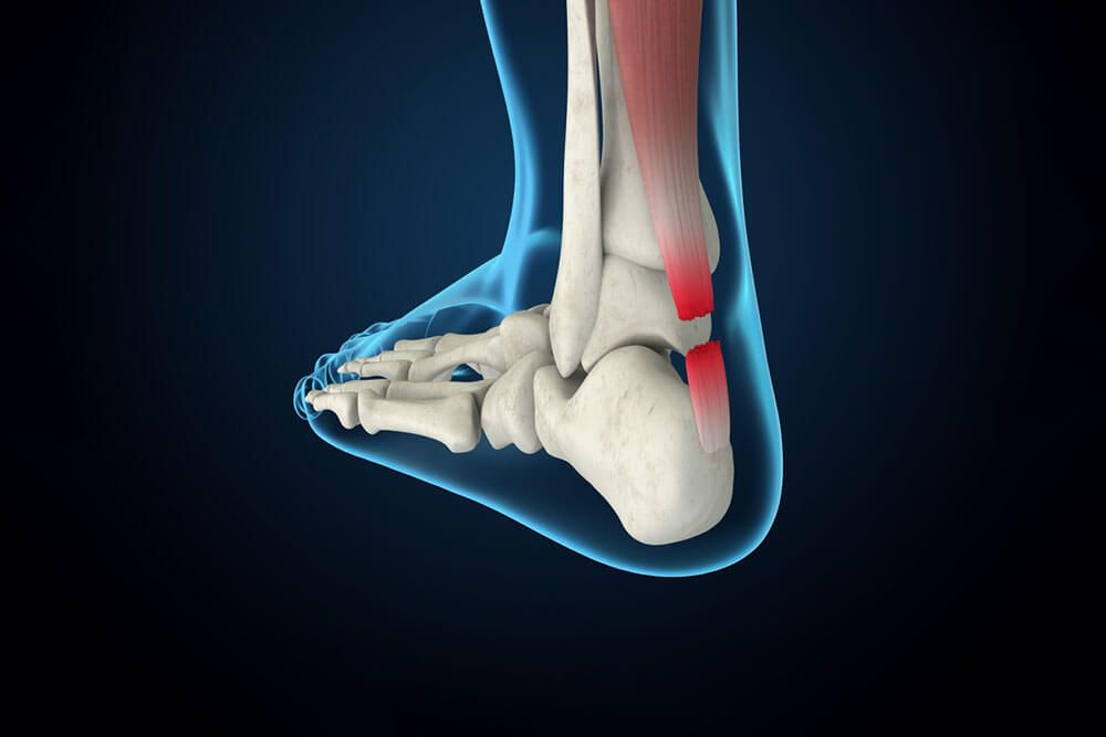 Achilles Tendon Rupture 3D Rendering