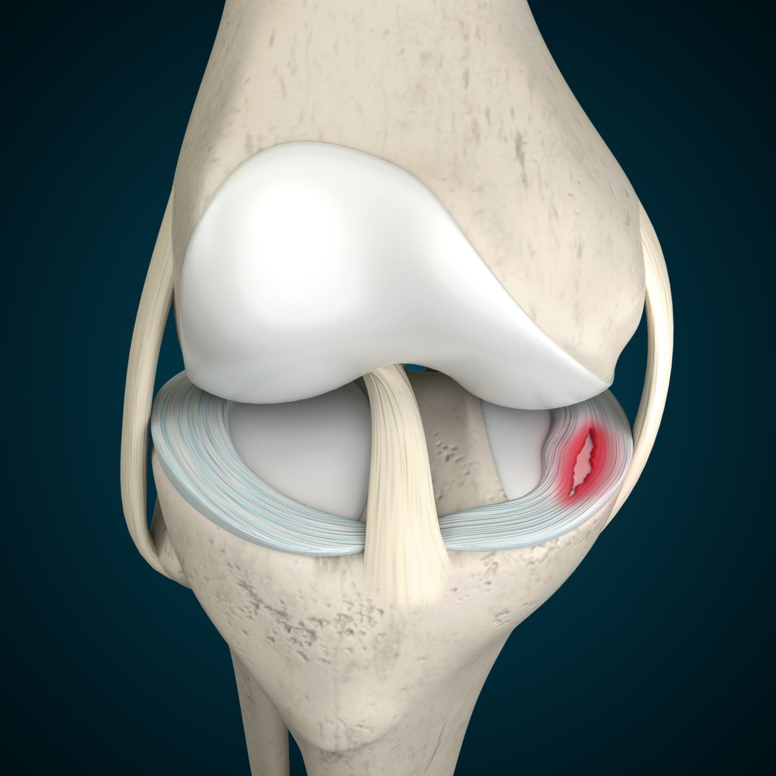 Meniscus Tear 3D Rendering, Knee Anatomy, Knee Pain