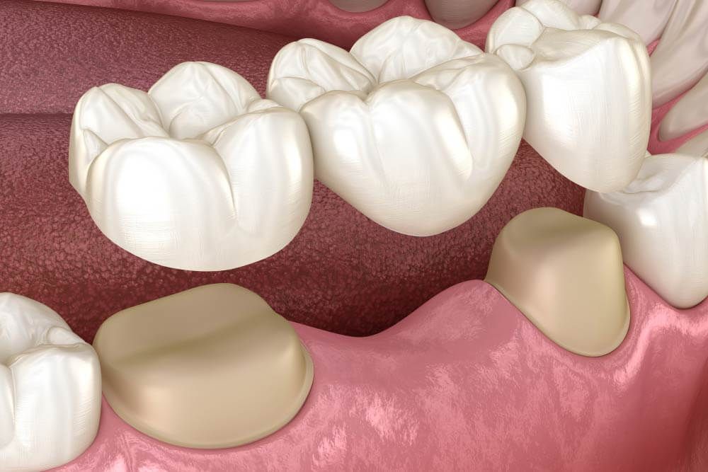 Dental bridge of 3 teeth over molar and premolar