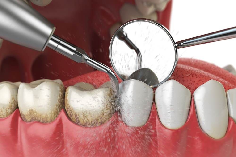 Ultrasonic teeth cleaning machine delete dental calculus from human teeth.